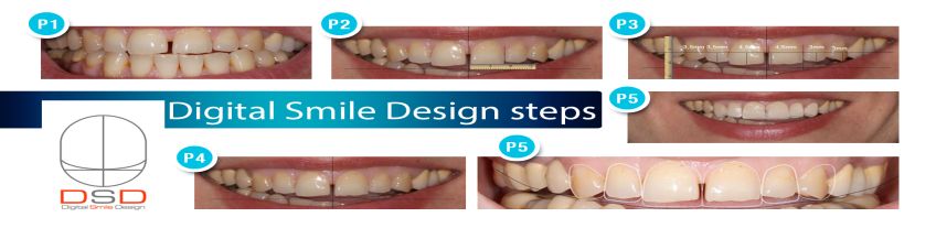 Digital Smile Design (Esthetic dentistry, Digital Smile Design)